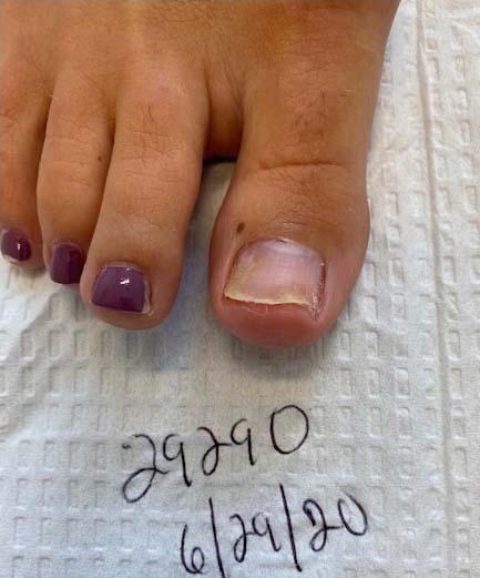 Toenail Fungus Before And After Photos Advanced Podiatry Of Manhasset Huntington Coram